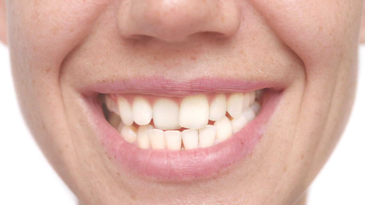 Enhancing the Smile by Straightening Crooked Teeth