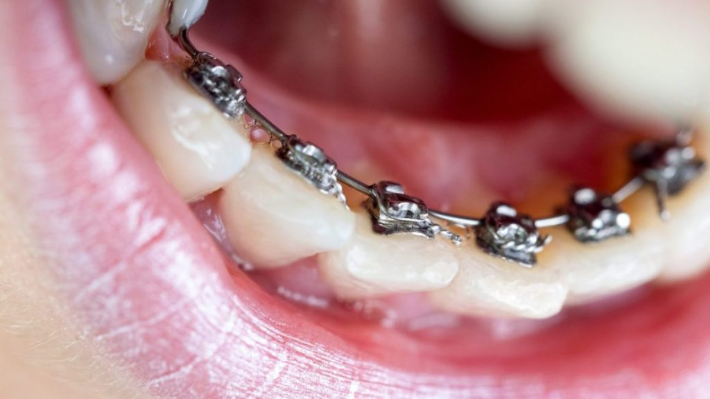 How much does a lingual orthodontic appliance cost